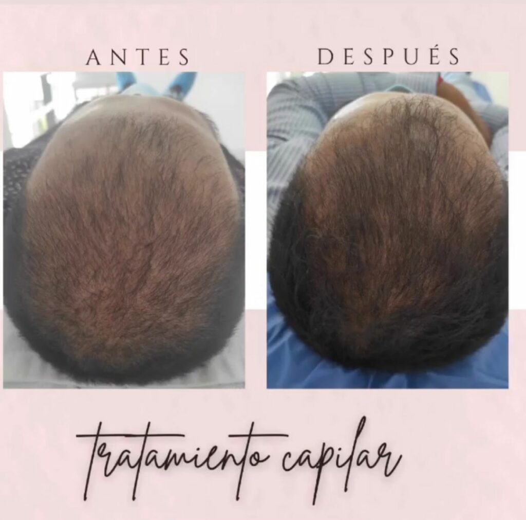 tratamiento crecimiento de cabello en quito